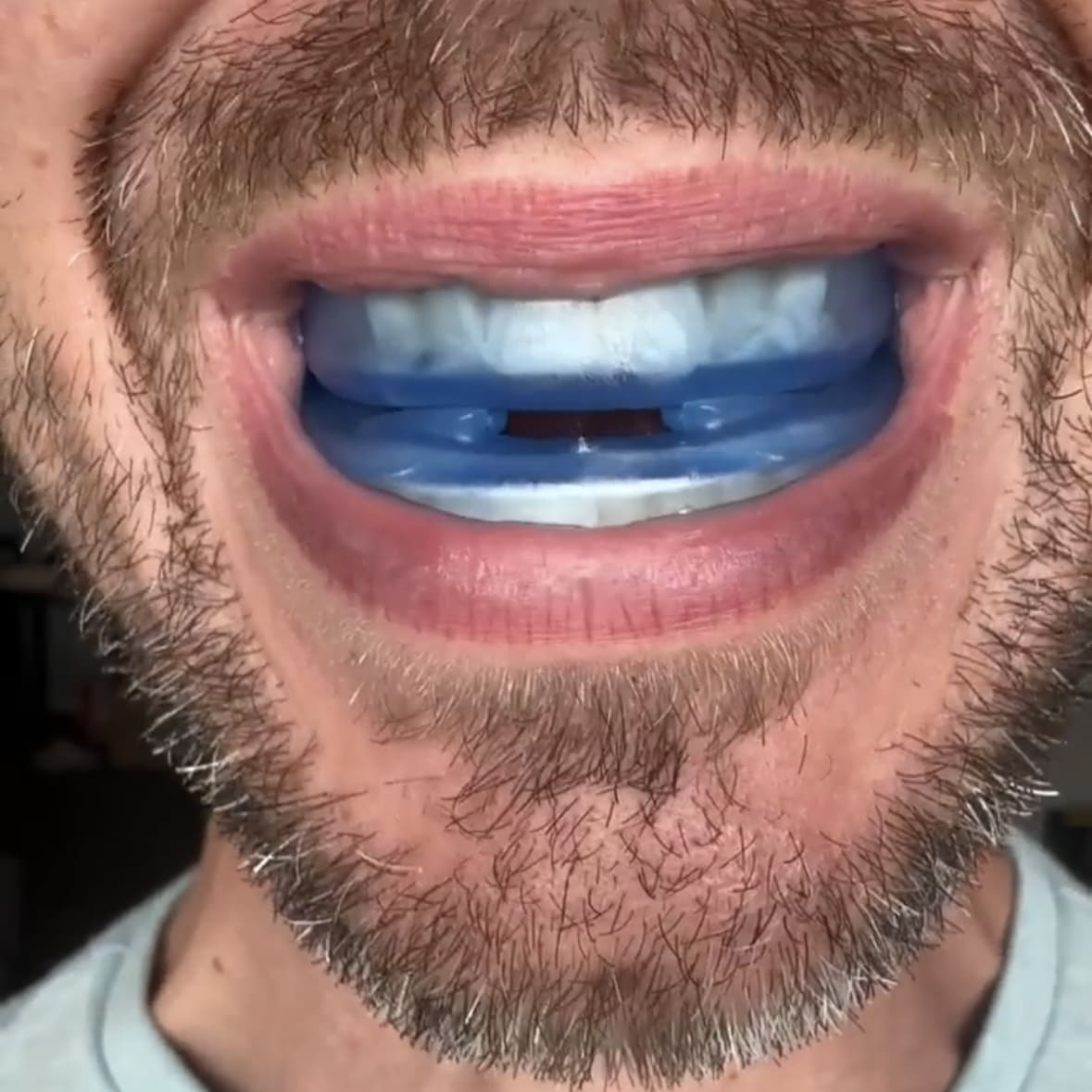 Honex Silent Sleep Snore Guard